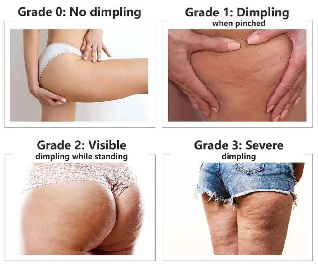 Representation of the stages of cellulite development Weybridge